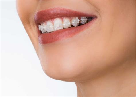 precio brackets metalicos vitaldent|brackets metalicos.